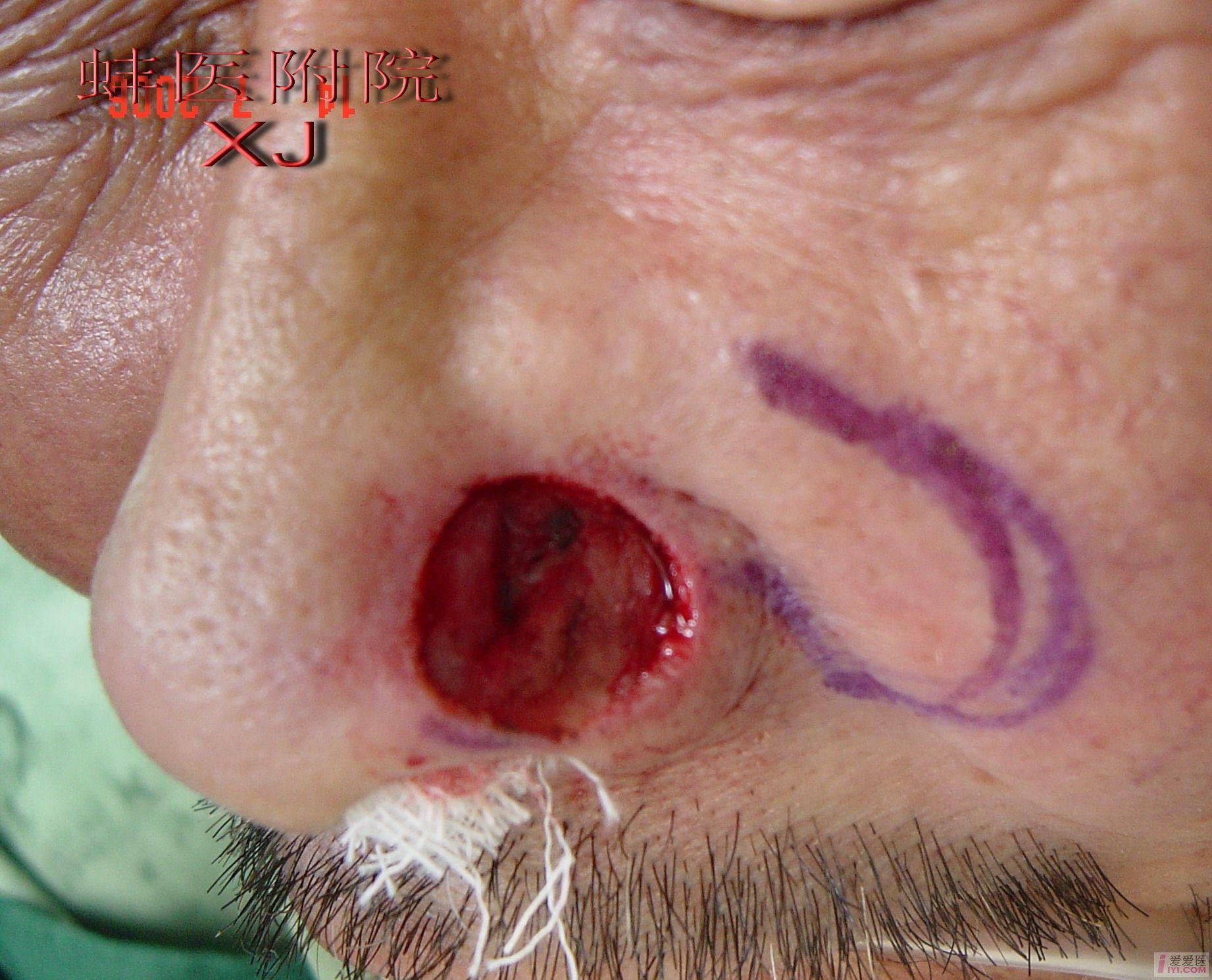 多图!实用!各种方法鼻翼缺损的修复!