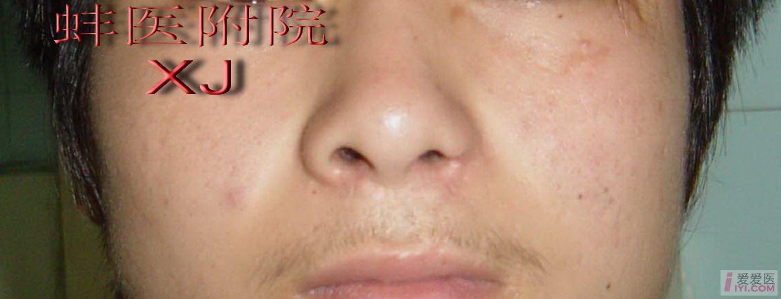多图!实用!各种方法鼻翼缺损的修复!