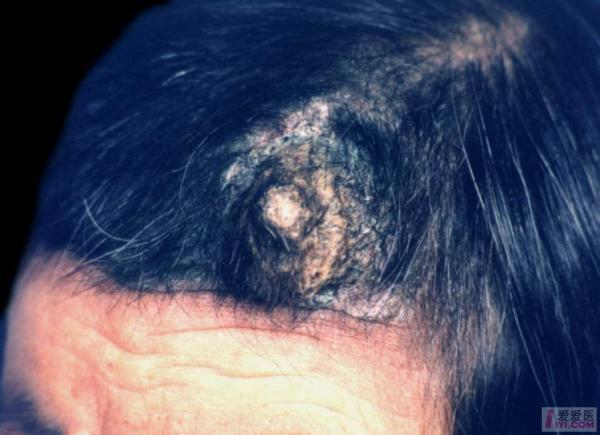 皮肤黏膜念珠菌感染图片