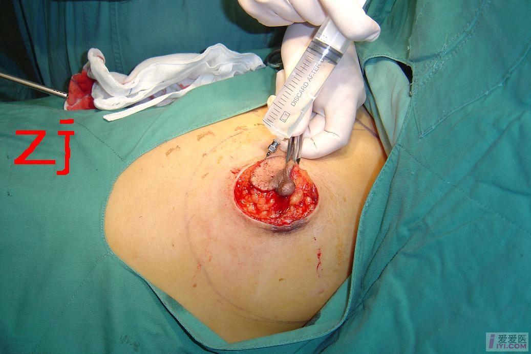 乳房切除后再造术图片图片