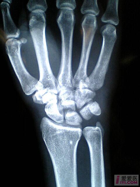手腕豆状骨骨折图片