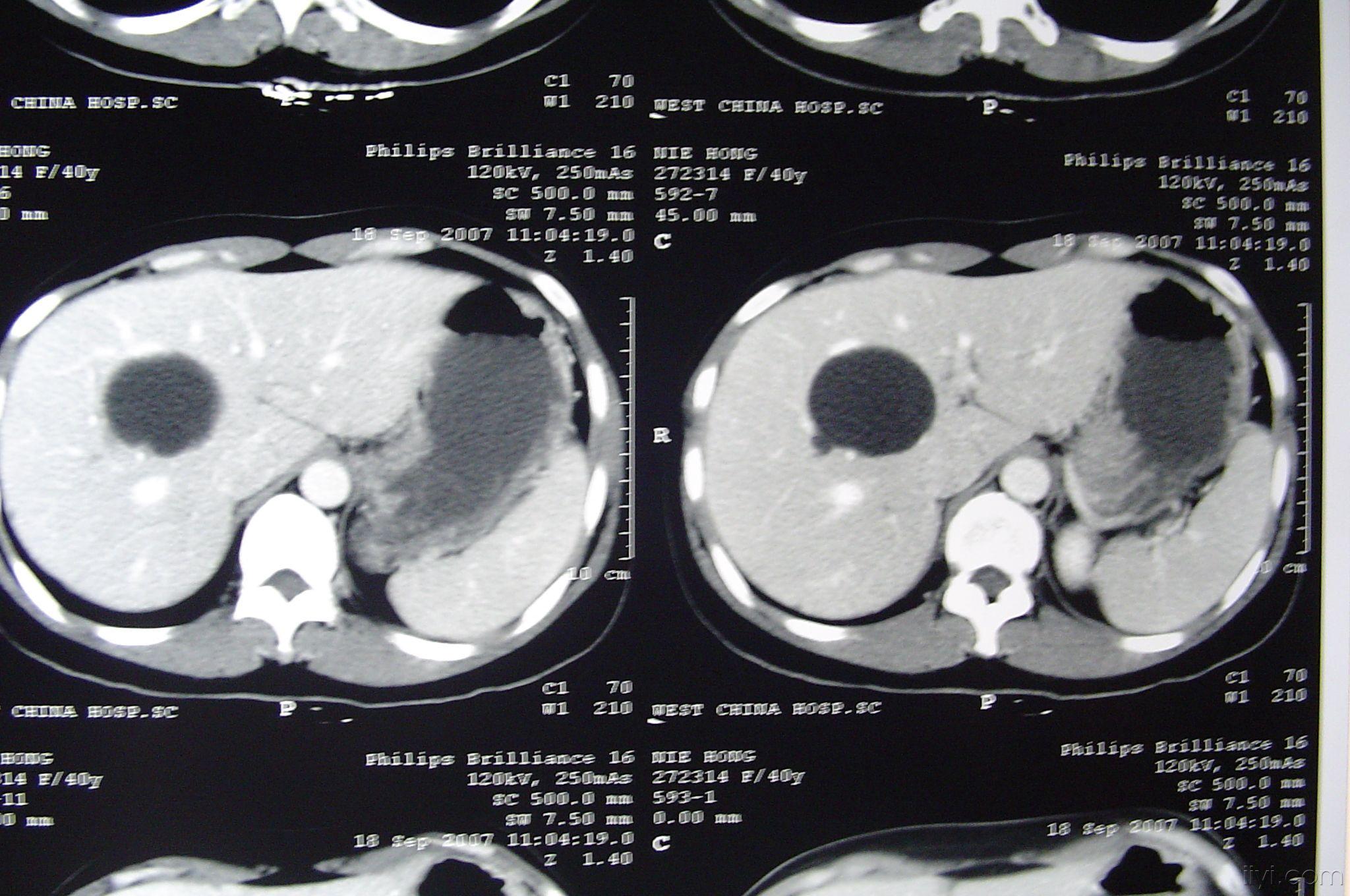 肝囊肿ct表现图片