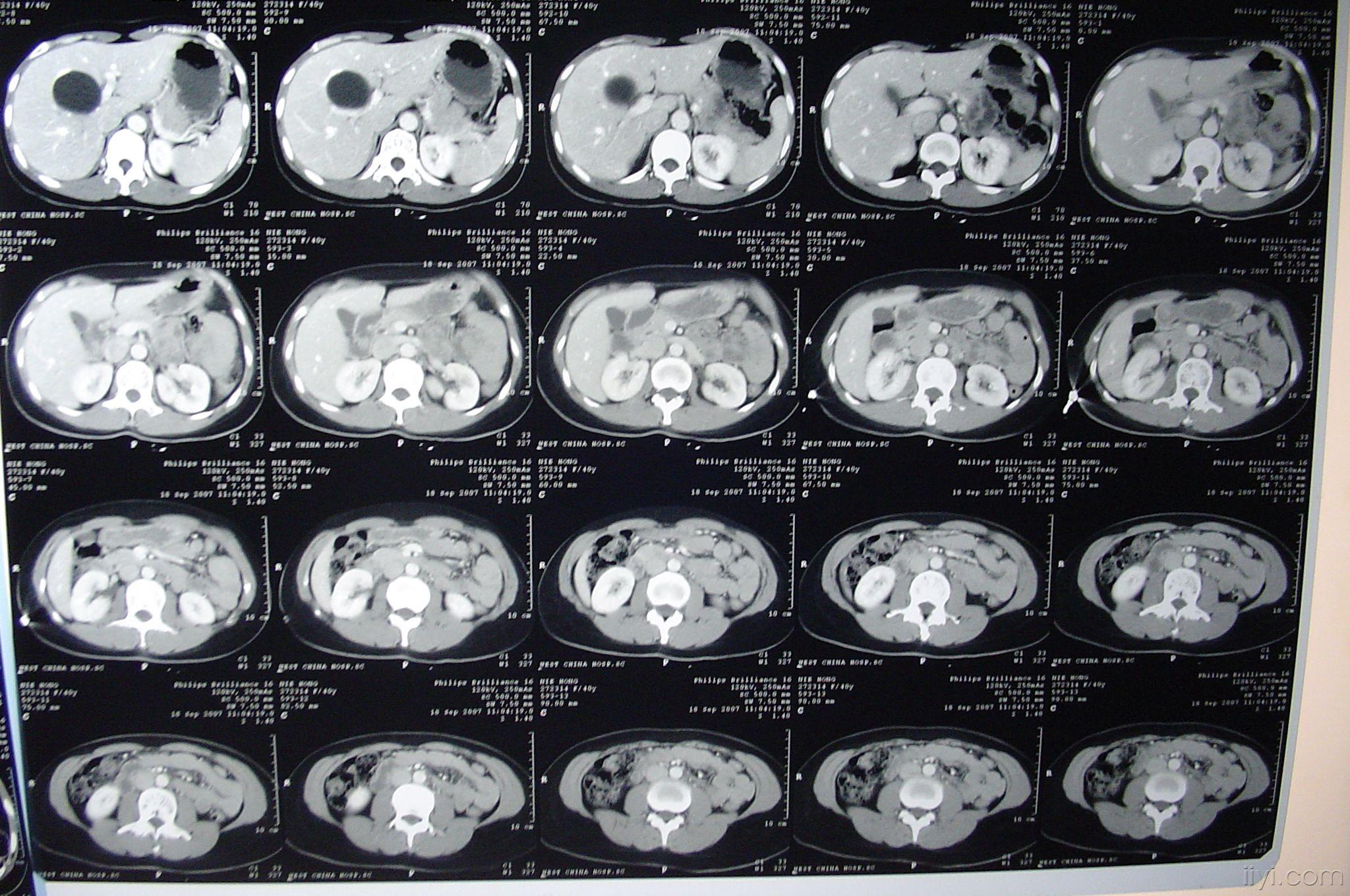 急!讨论--位于肝门静脉的囊肿治疗方案