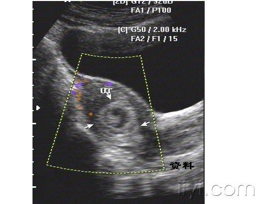 子宮前位,輪廓清晰,包膜完整,於子宮橫切位可探及兩個宮腔,呈