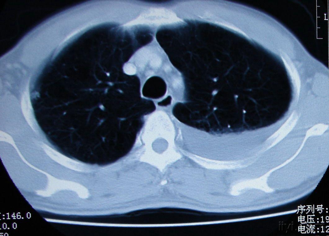 左肺病变,请各位讨论,病理结果已公布.