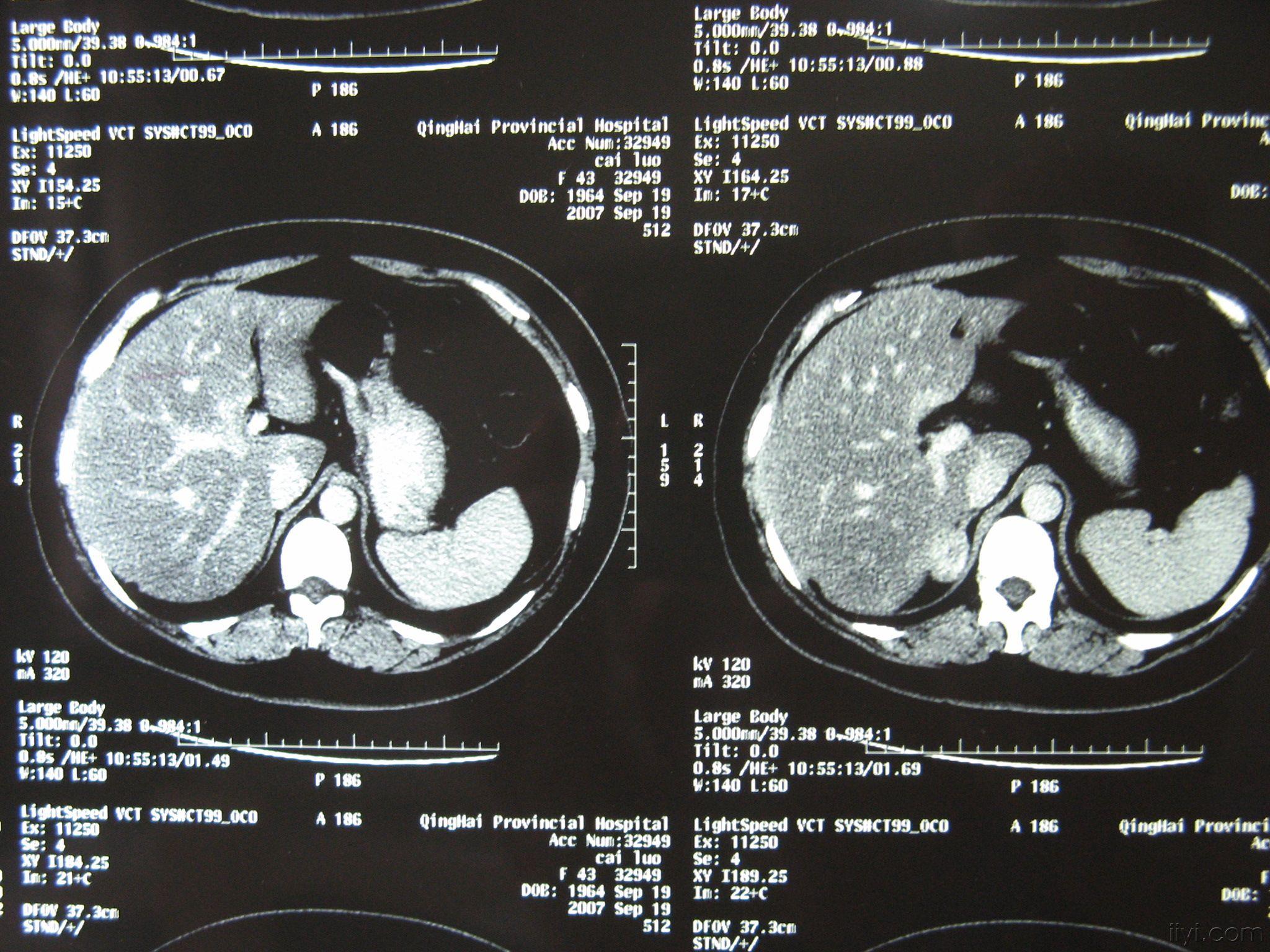 ct肾上腺图像图片