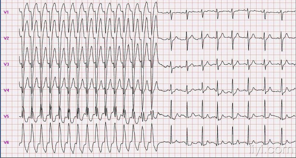 宽大的qrs波的心电图图片