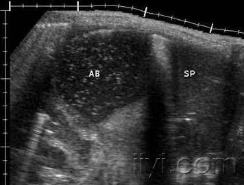 脾脓肿 病人发热,脾区疼痛.超声发现脾内8cm大的无回声区,欠规则.