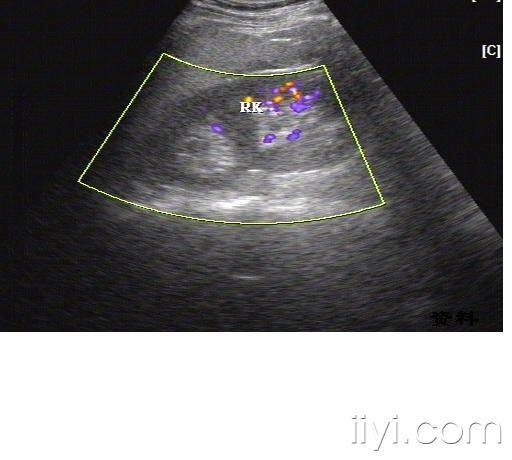 重复肾超声表现图片图片