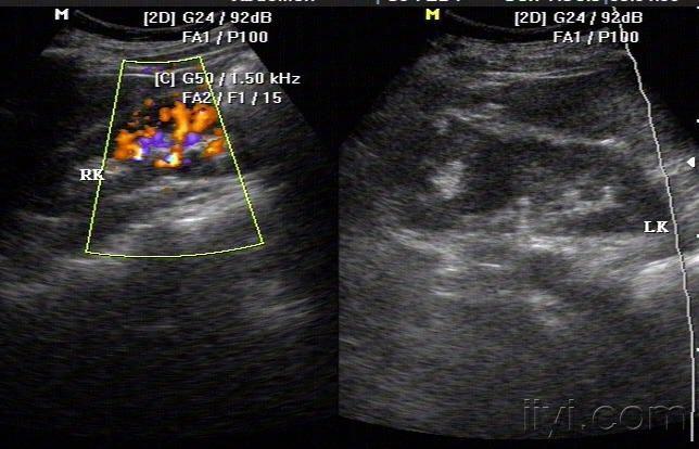 重复肾超声表现图片图片