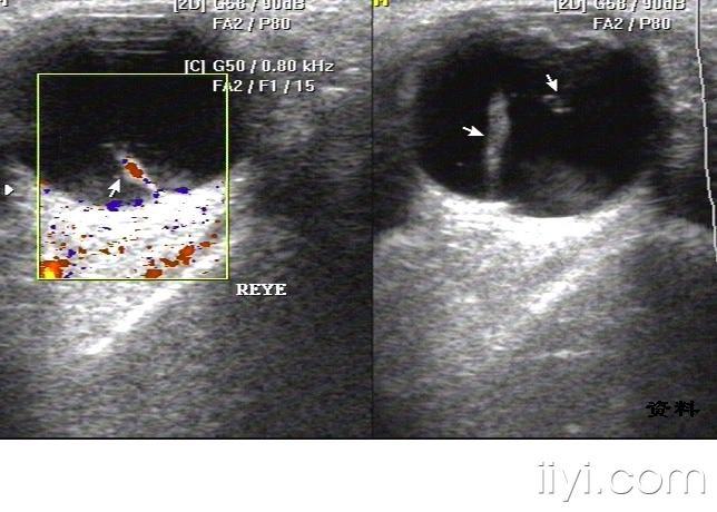 视网膜部分脱离 - 超声医学讨论版 - 爱爱医医学论坛 - 爱爱医医学网