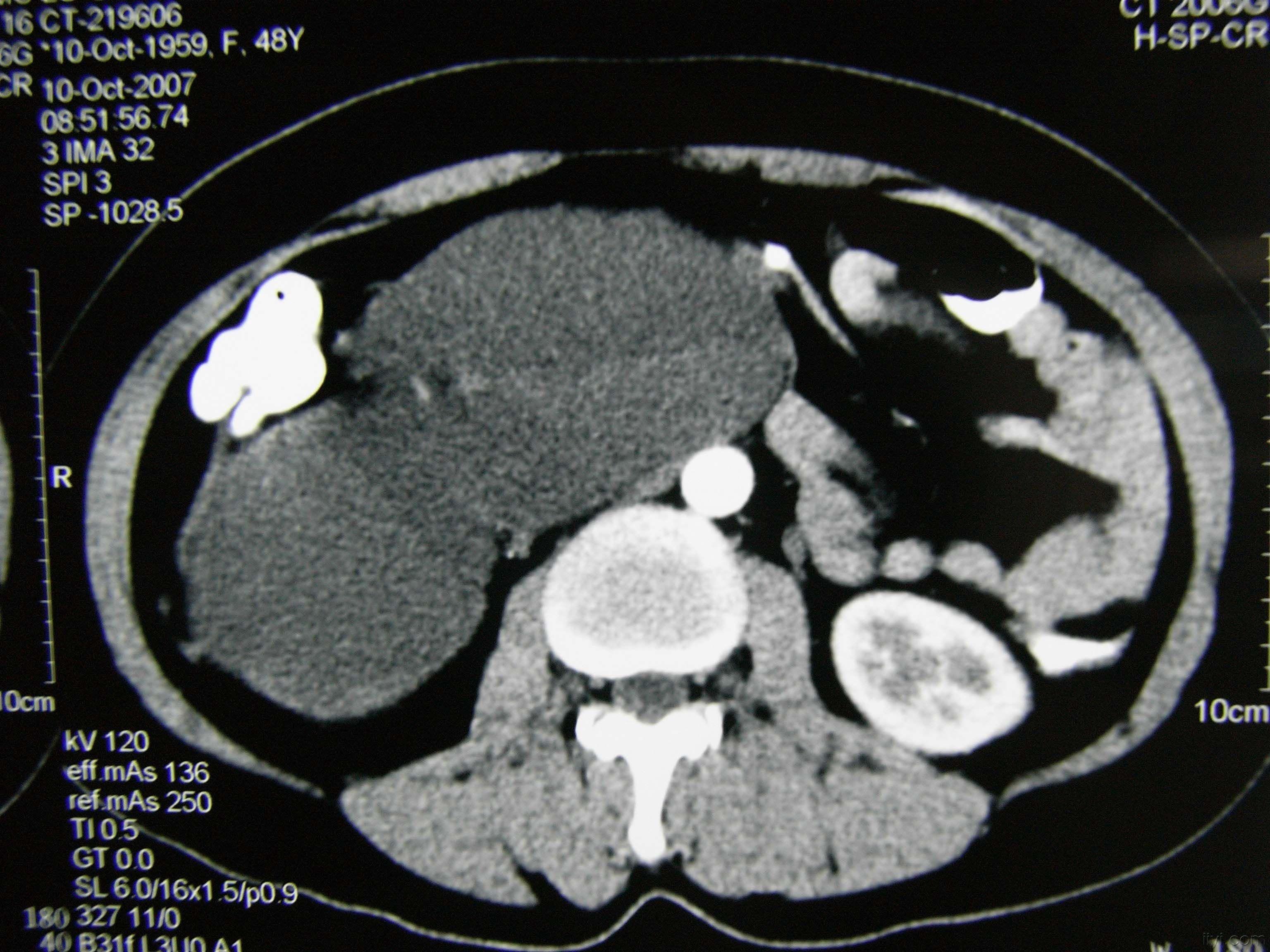 巨大肾肿瘤一例(附典型ct,ivp造影片)