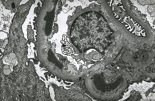 急进性肾小球肾炎电镜图片