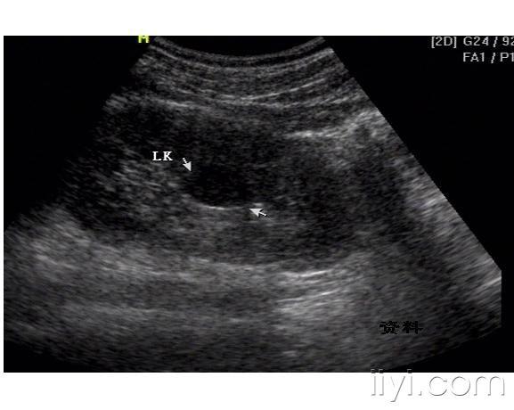 右侧肾盂积水并右侧输尿管扩张并左肾低回声区