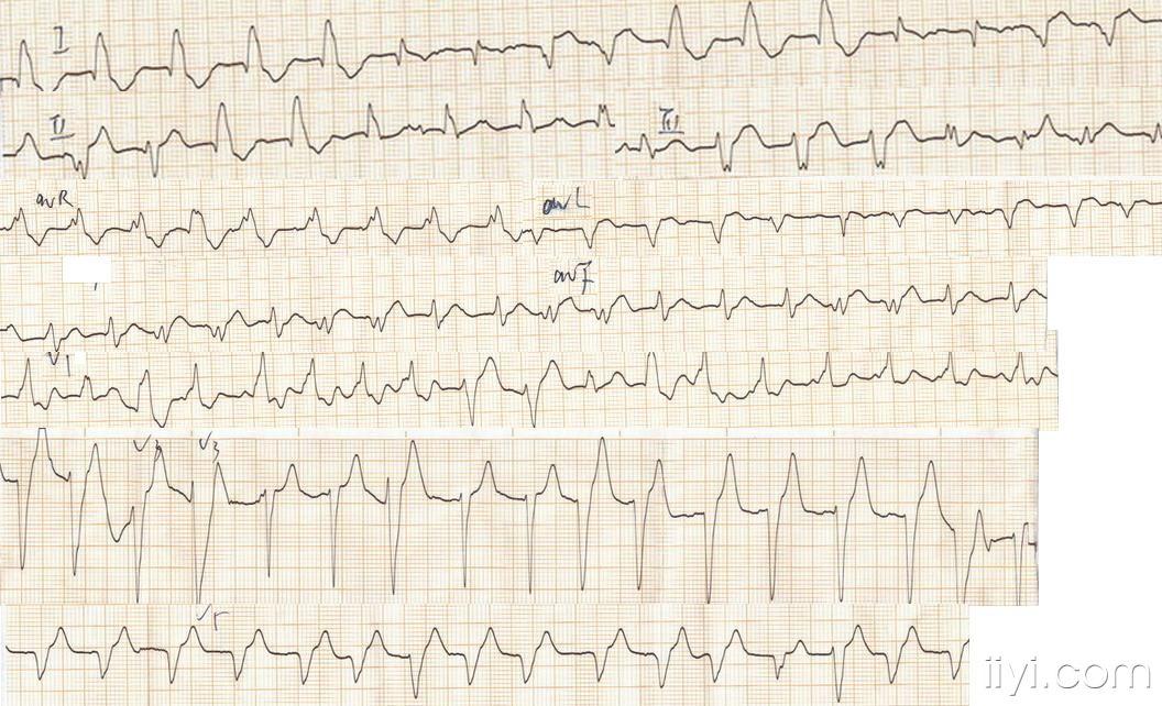室上性心律心电图特征图片