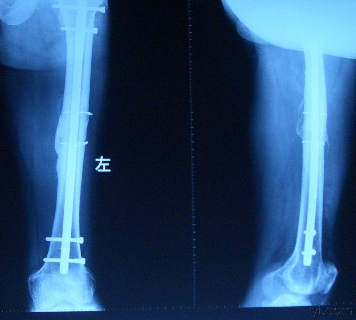 股骨干骨折愈合图片