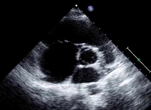 胡^_^涂说心超之---三尖瓣下移畸形 - 超声医学资源版 - 爱爱医医学