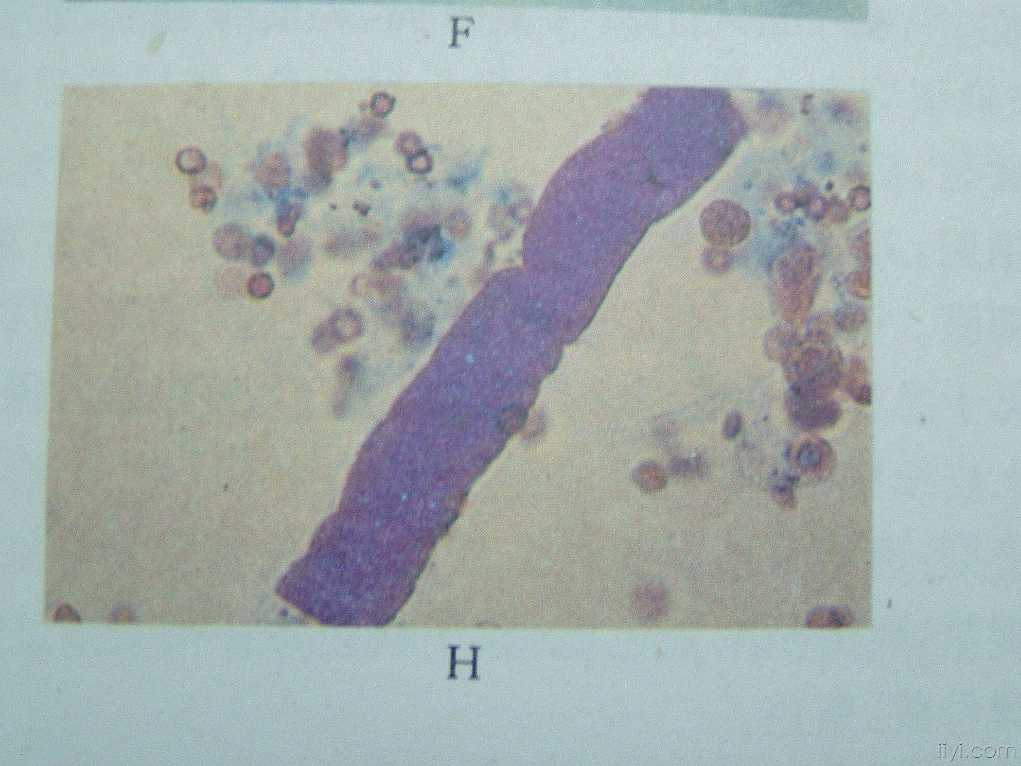尿液管型图谱图片