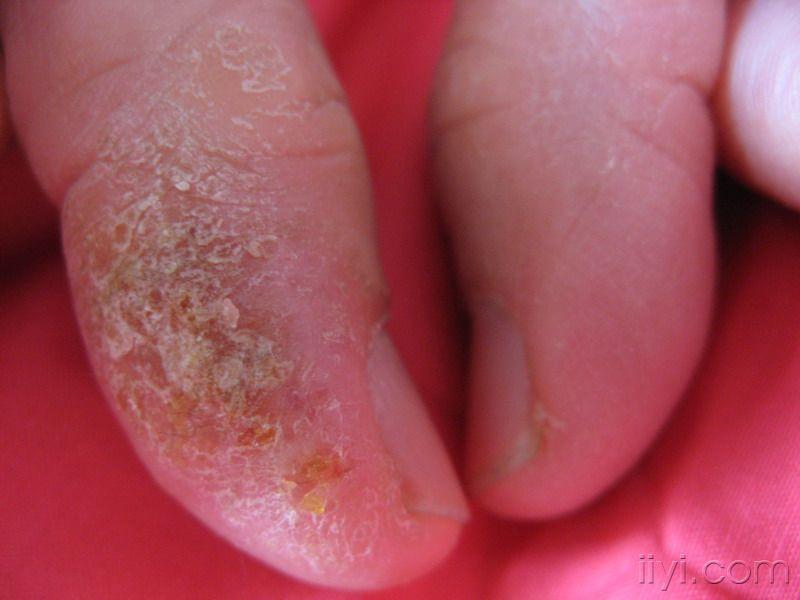 手指患上类似湿疹症状且1年半未好,着急!