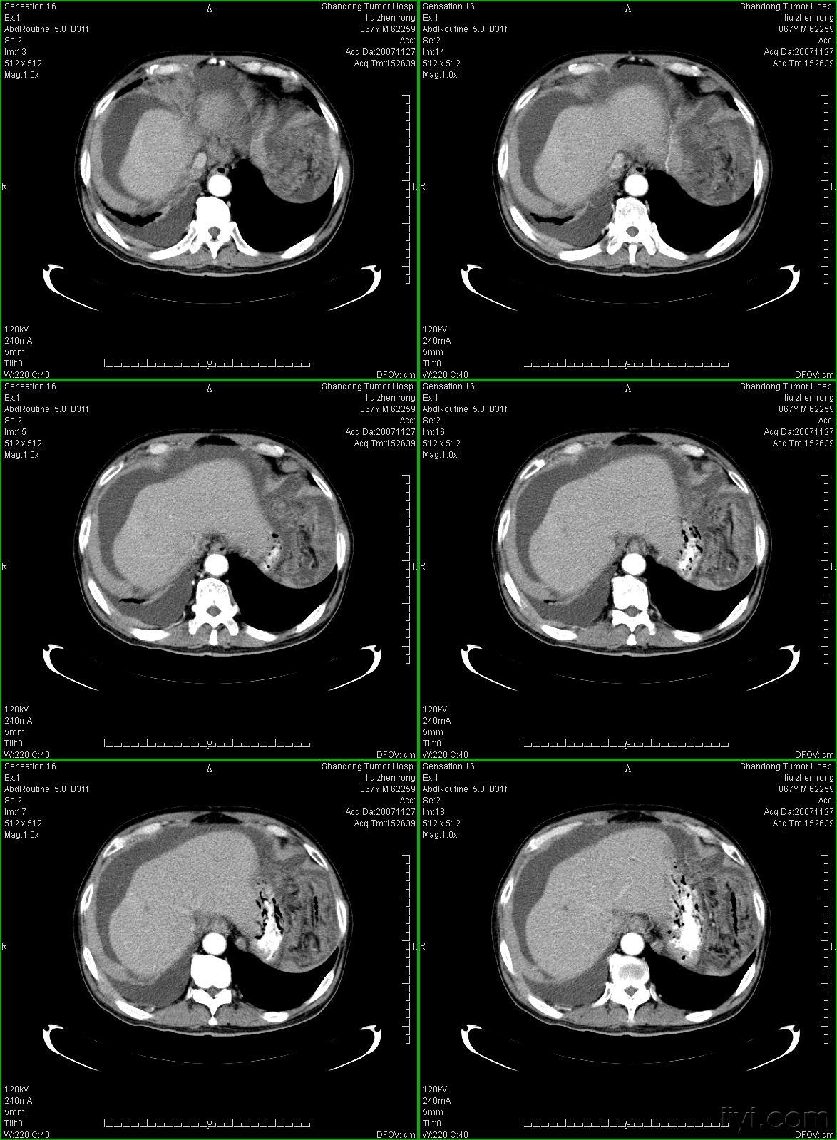 典型的大网膜,肠系膜转移瘤,很经典