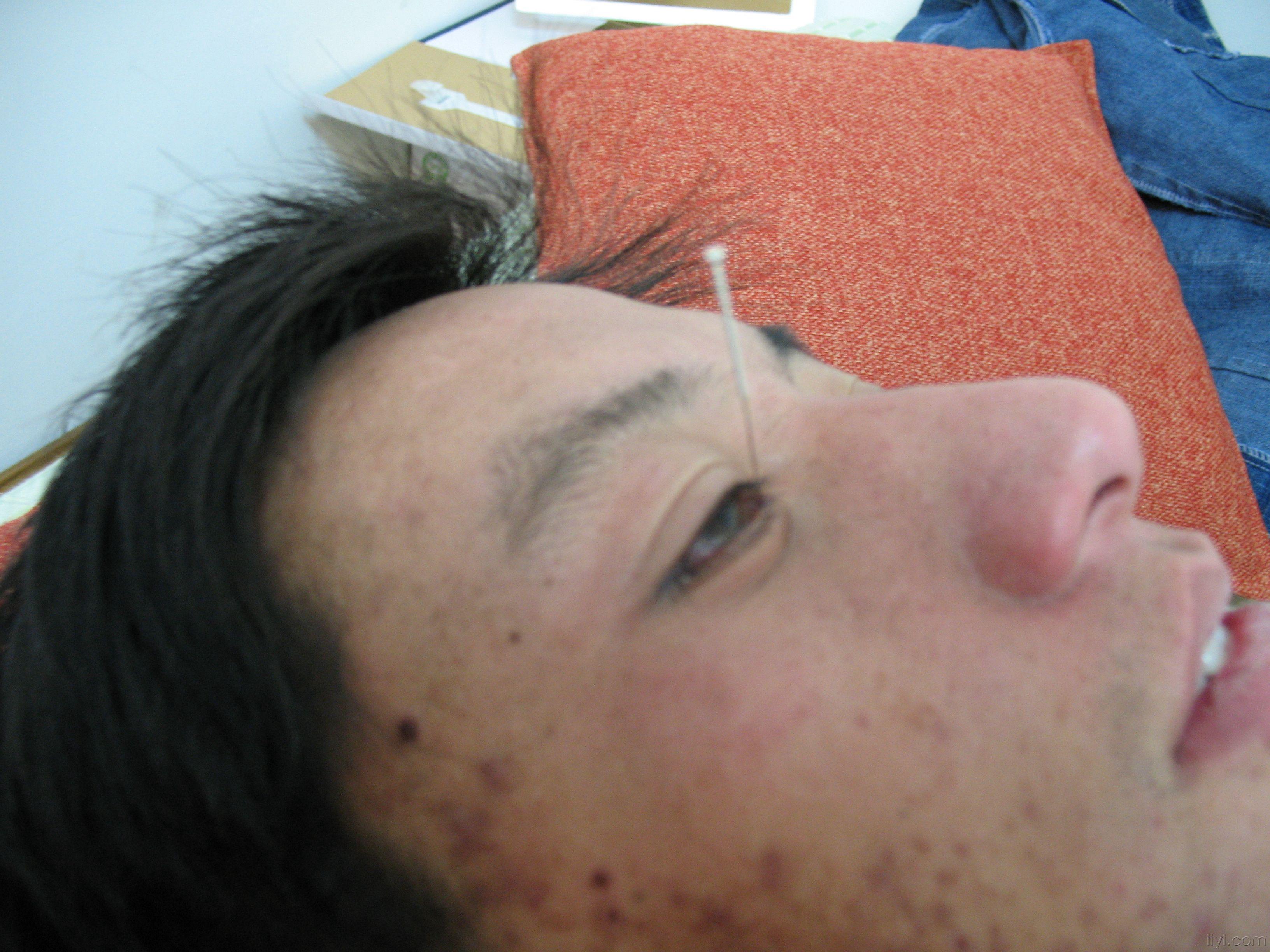 面瘫眼睑开合不好(附图片)的治疗