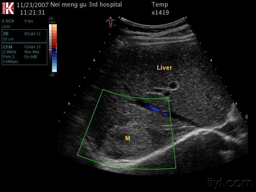 肝血管瘤图片彩超图片