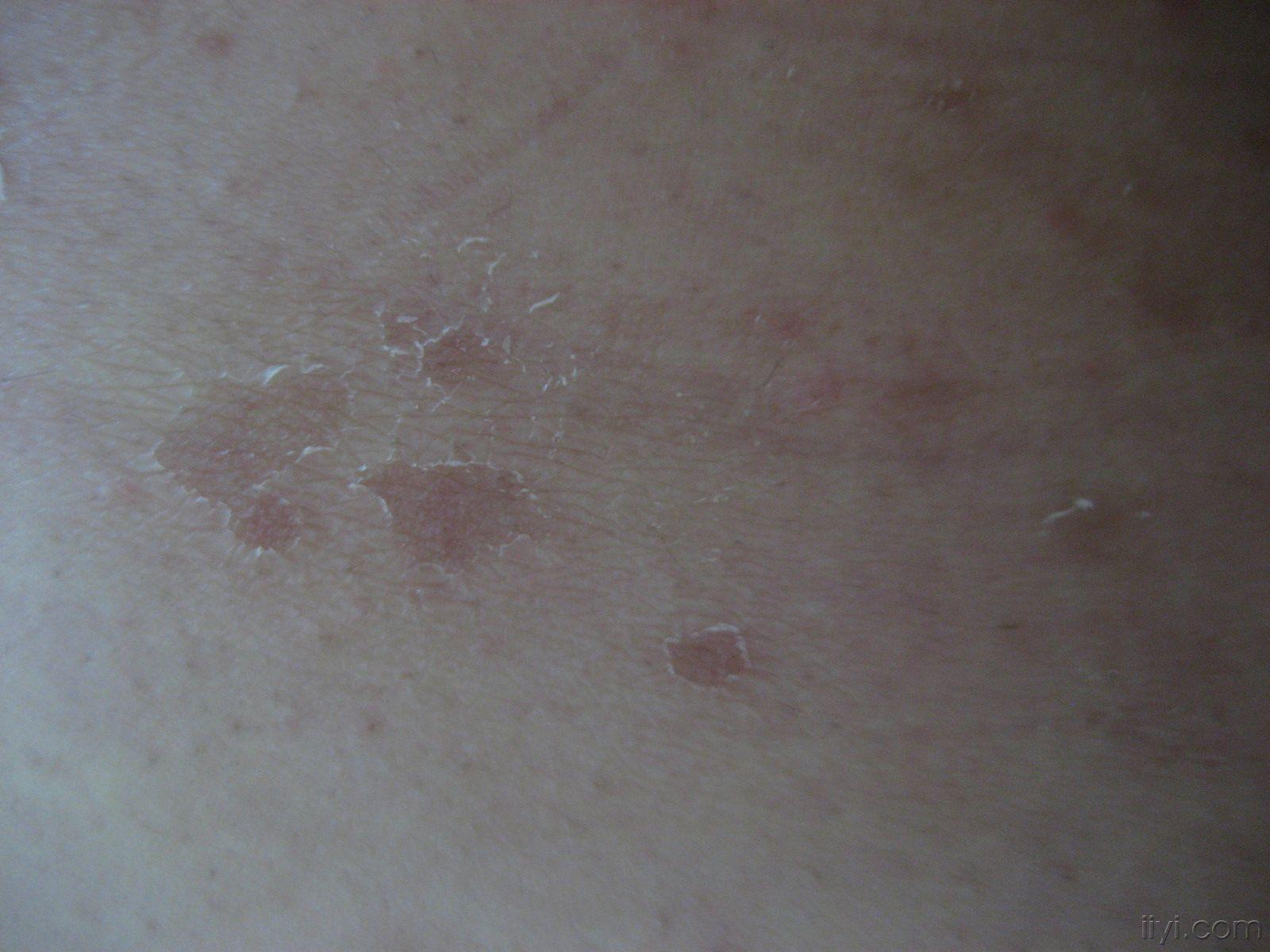 楼主心存感恩2007-12-09 14:26:10大概在六月份腰部出了指甲大点癣斑