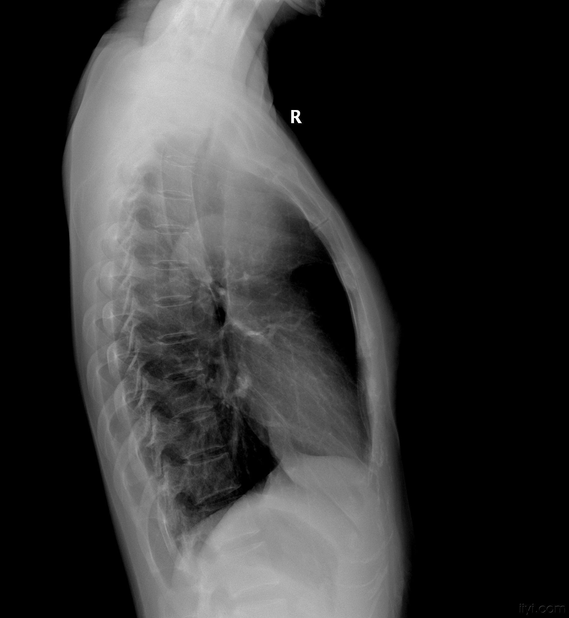 少见病例,大家看看象啥.(已经公布病理: 胸内甲状腺肿)