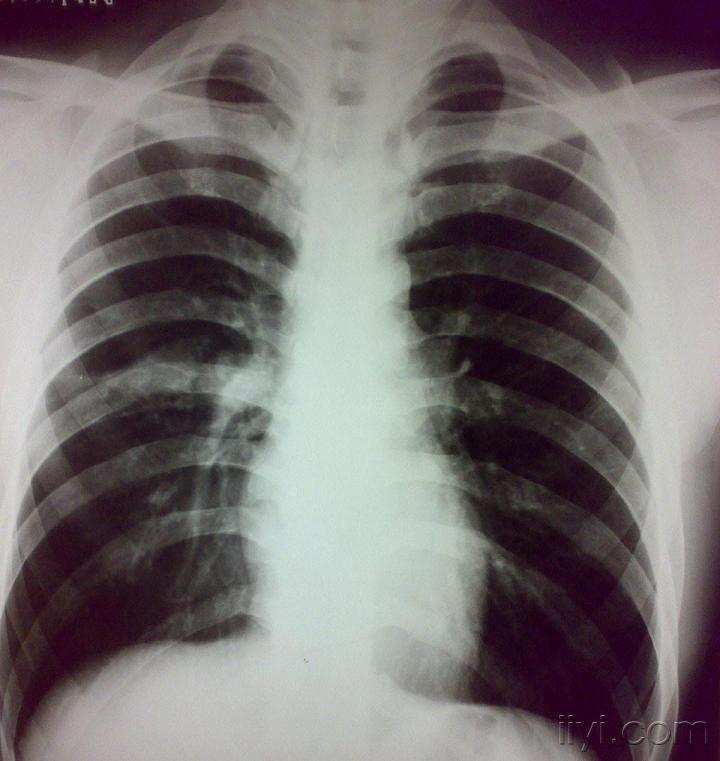 胸壁结核图片