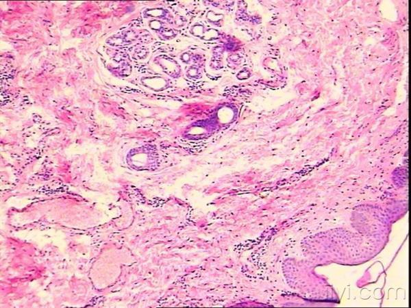 2.外阴白斑?  [ 本帖最后由 pathology 于 2008-1-5 23:31 编辑 ]