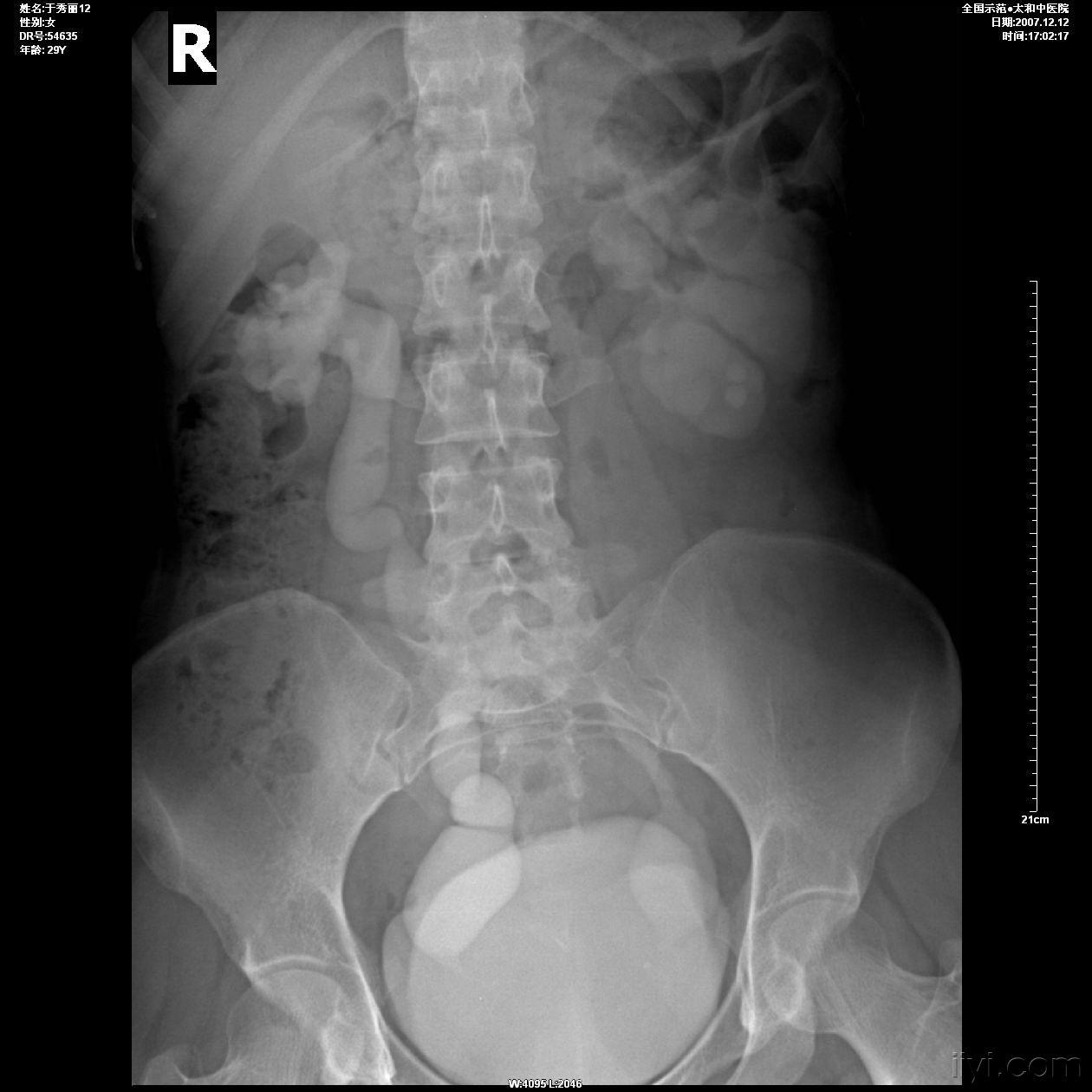 及双侧输尿管明显扩张,膀胱无异常改变;超声意见:左肾下极多发结石,双