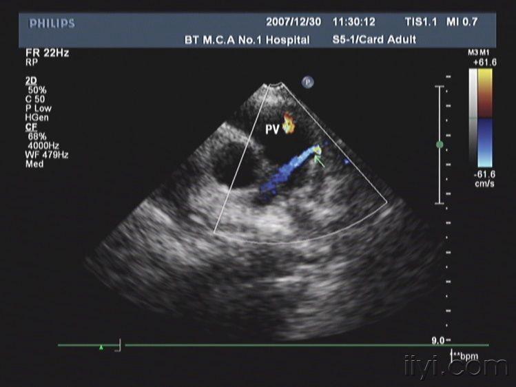 冠状动脉瘘超声诊断ppt图片