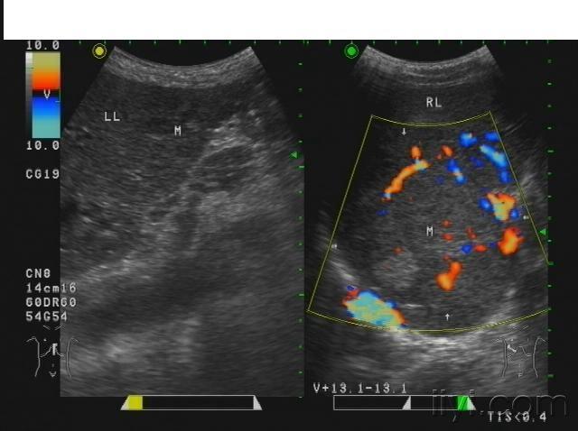 酒精肝超声声像图图片图片