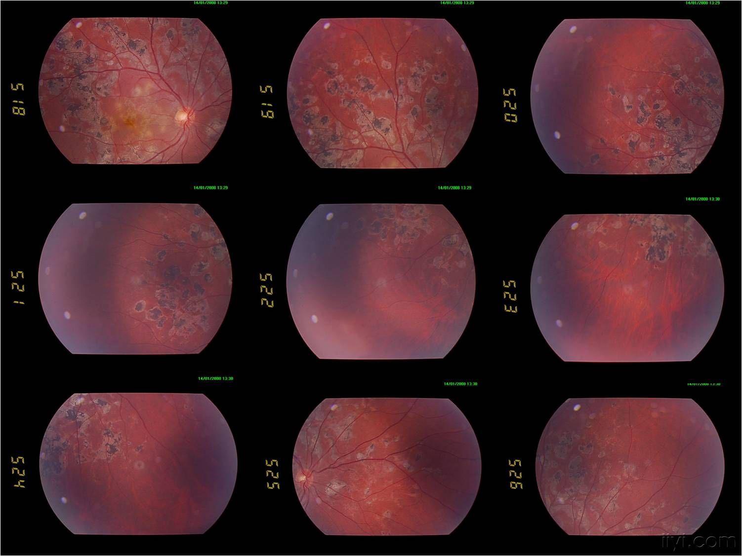 中心性浆液性视网膜病变?