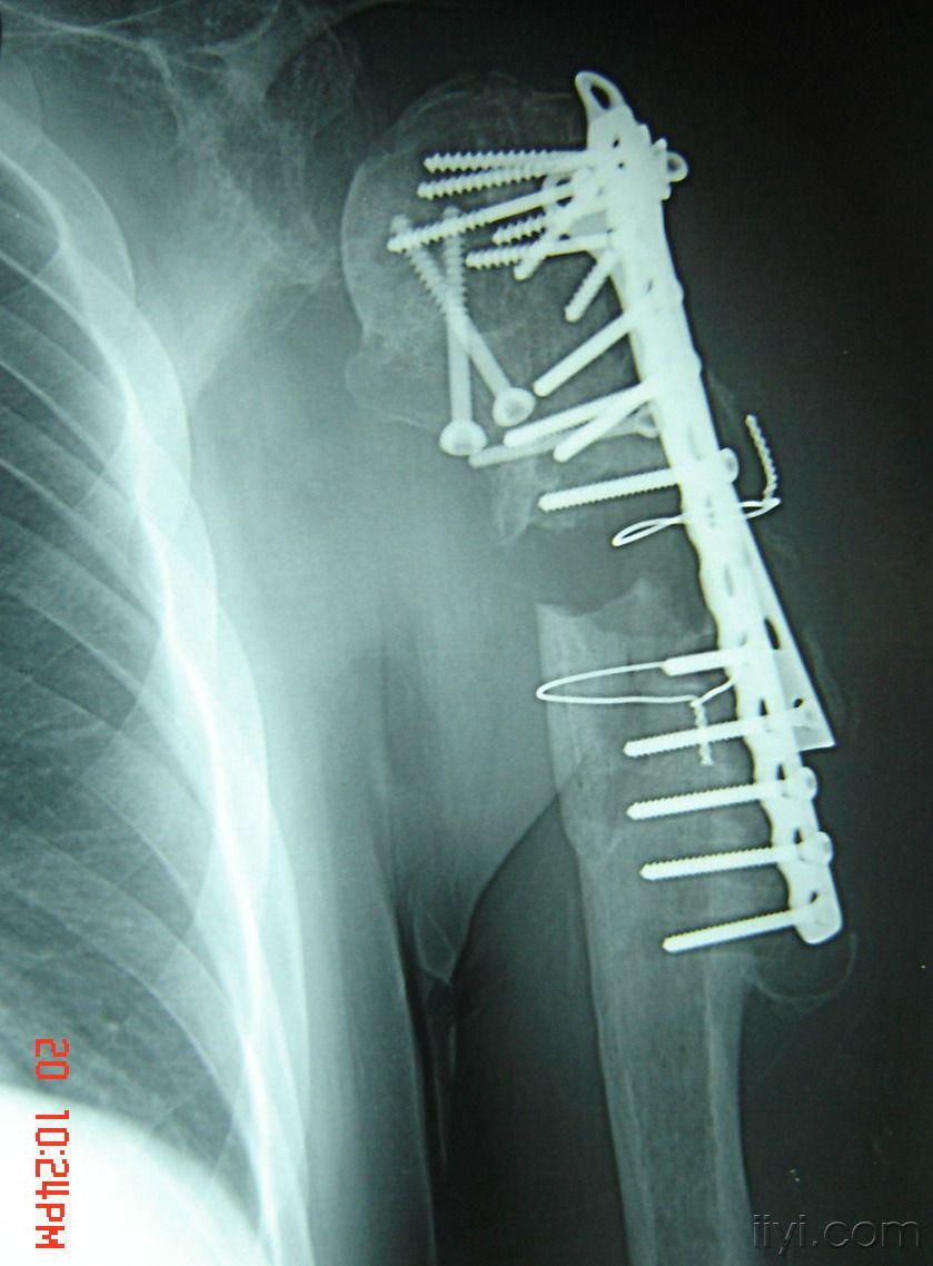 肱骨近端骨折17个月骨不连