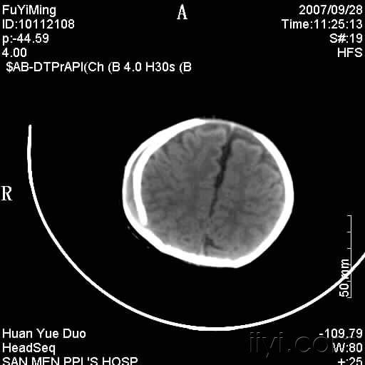 婴儿头皮血肿钙化图片图片