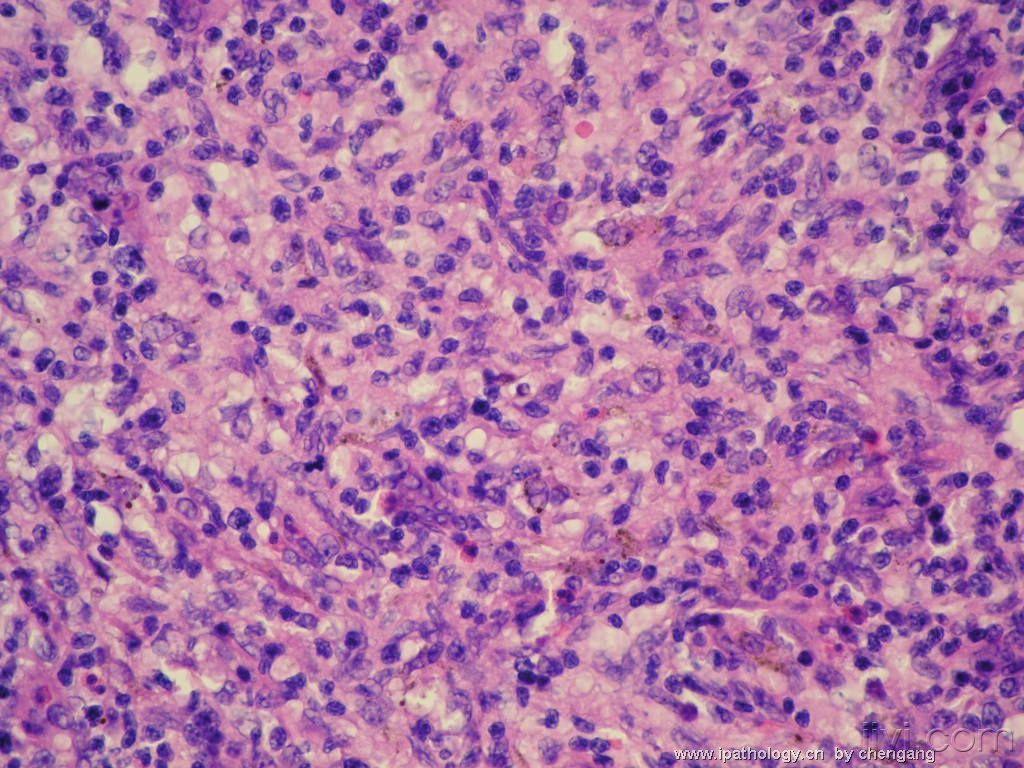 20:43:35淋巴结部分淋巴滤泡保留,滤泡间区和副皮质区增宽,呈结节状和