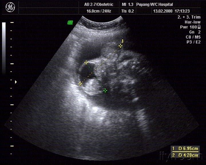 畸胎瘤的超声图像图片