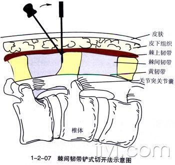 庞继光的 针刀入路示意图