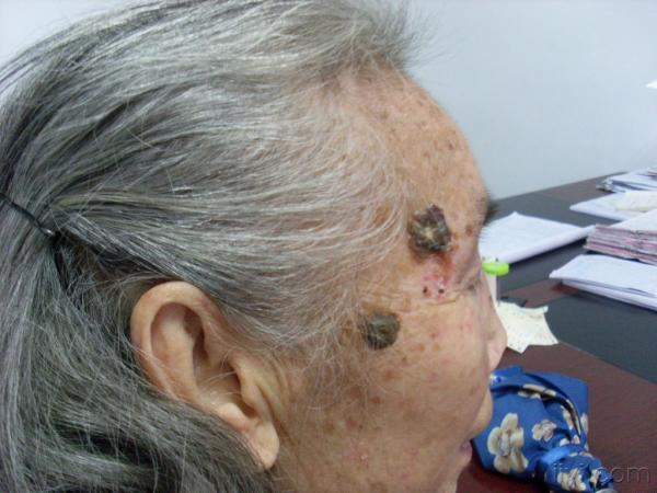 21:03:001:银屑病 2:白癣 3:基底细胞上皮瘤 4:皮肤淀粉样变