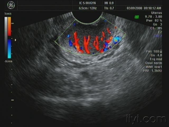 宫颈占位(宫颈鳞状细胞癌)