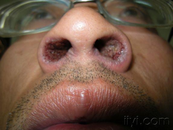 鼻粘膜溃疡的症状图片图片