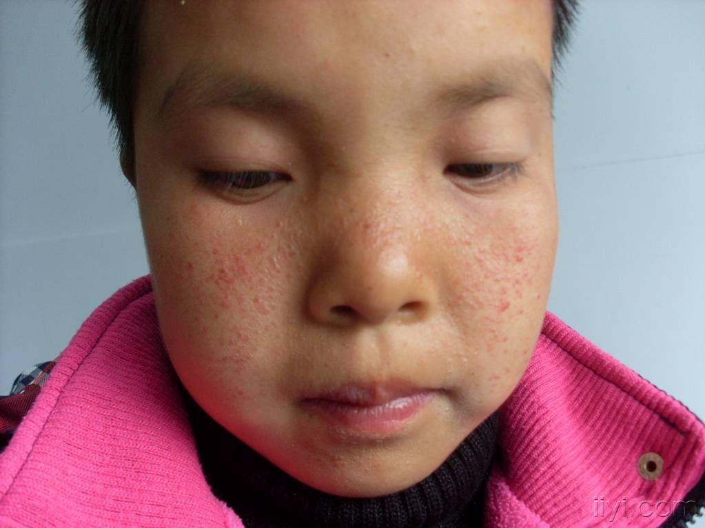 皮肤及性传播疾病讨论版 - 爱爱医医学论坛 - 爱爱医医学网