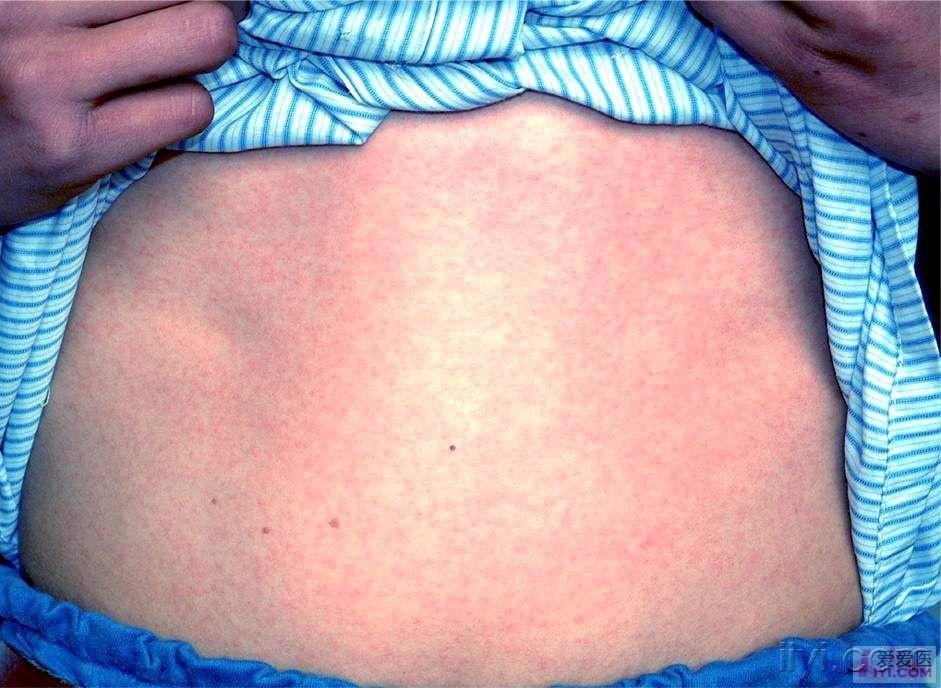 麻疹症状初期图片图片