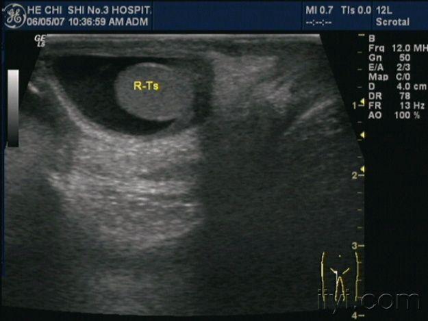 睾丸外鞘膜彩超图片图片
