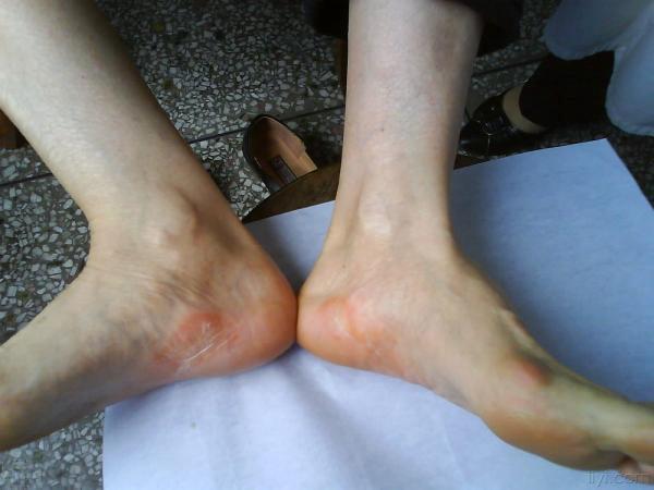 楼主duce70702008-04-19 07:38:15患者女,45岁,居民,因双足内外侧角化