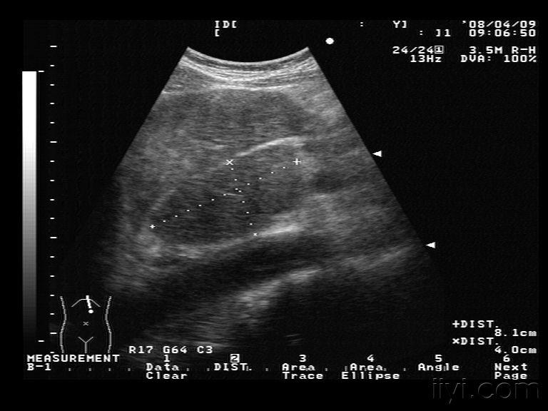 肝脏尾状叶超声图片图片