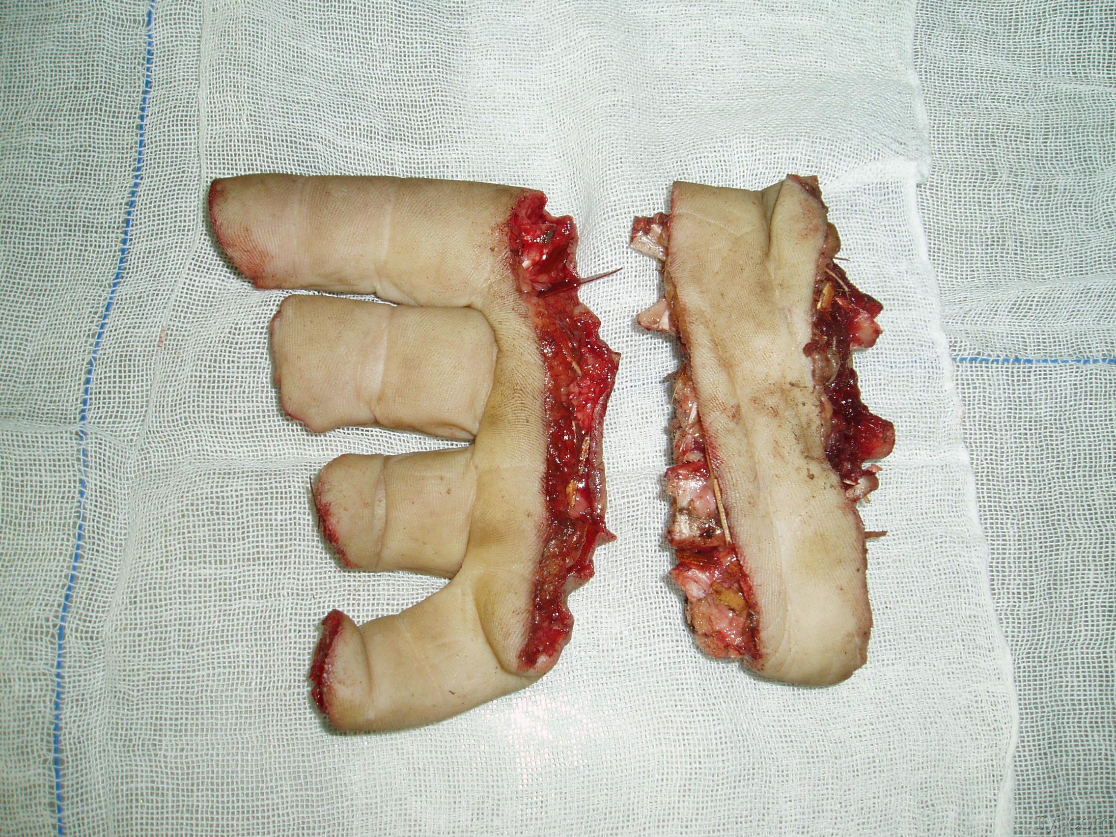 六指症手术图片