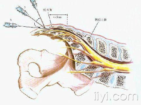 骶管阻滞图片