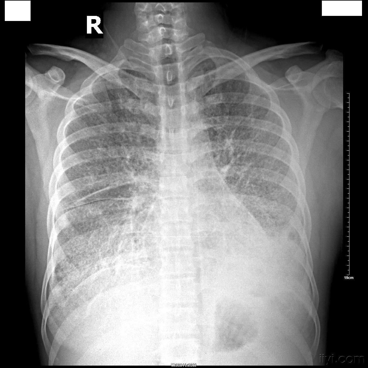 硅肺图片